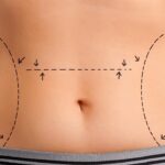 Liposuction & Tummy Tuck Surgery in Jaipur