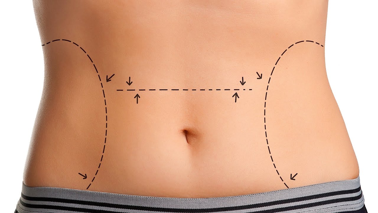 Liposuction & Tummy Tuck Surgery in Jaipur